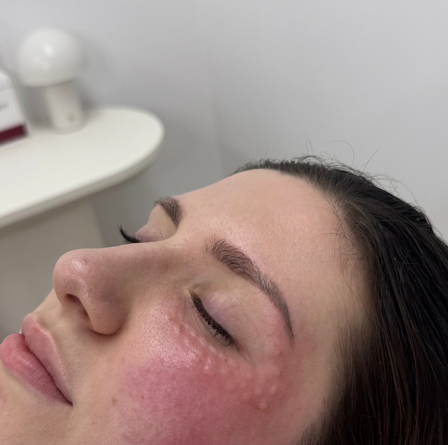 Salmon Sperm Facial Rejuran eyes and undereyes