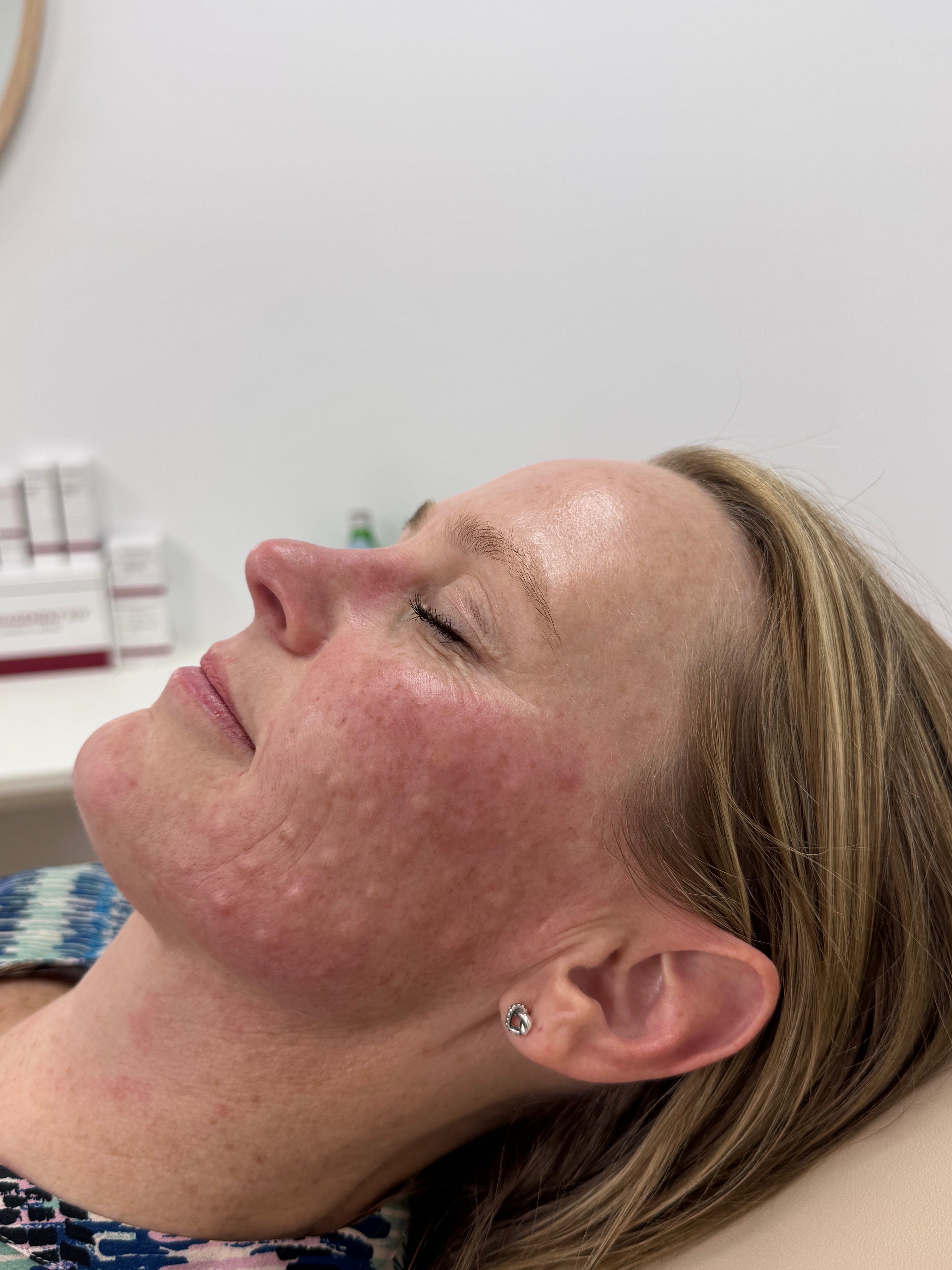 Salmon Sperm Injections Rejuran Classic Healer